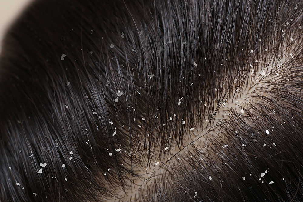 4 Essential Oils for Dandruff and Dry Scalp