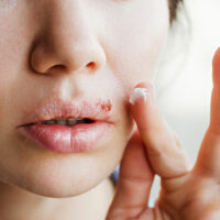 5 Tips to Avoid the Spread of Cold Sores