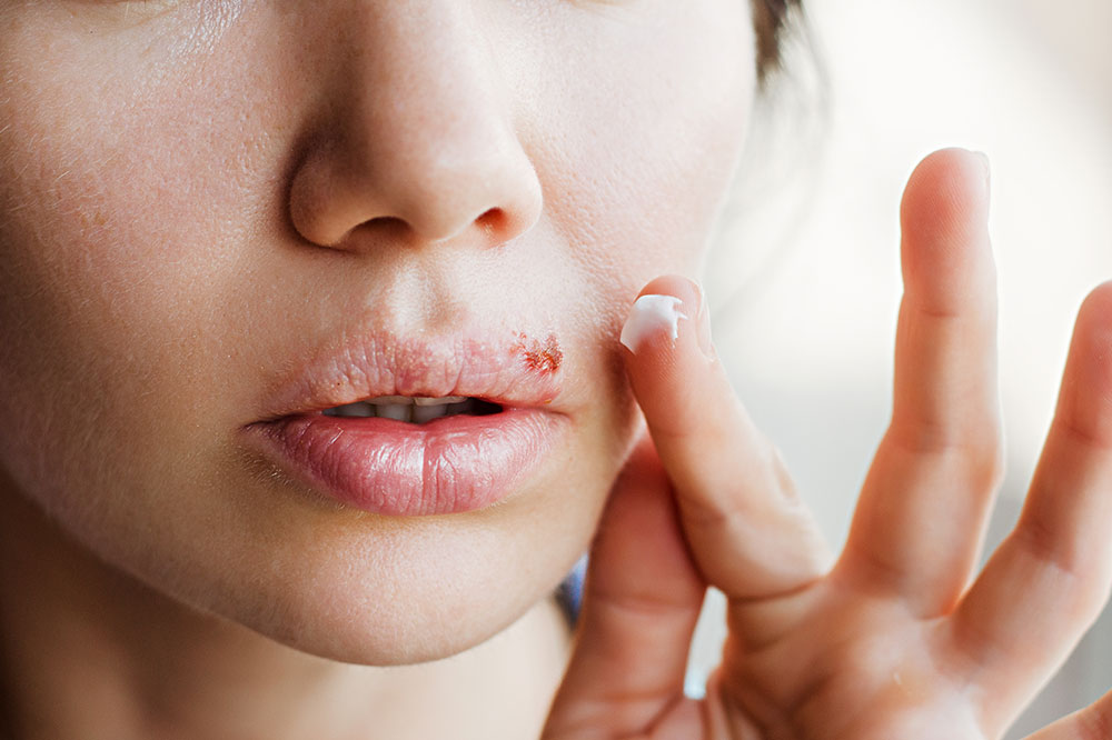 5 Tips to Avoid the Spread of Cold Sores