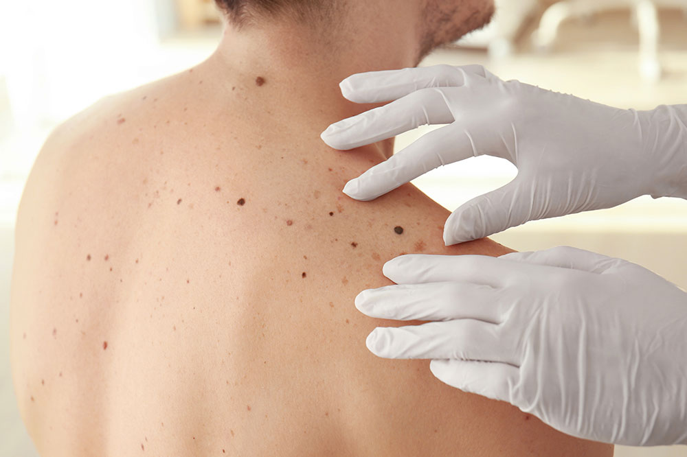 6 Causes of Melanoma