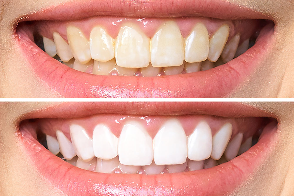 The Pros and Cons of Teeth Whitening